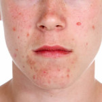 L’acne negli adulti