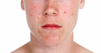 acne adulti