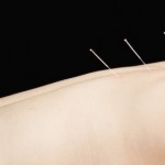 Curare l’ansia con l’agopuntura, cura alternativa per l’ansia