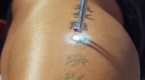 rimozione tatuaggi laser