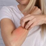 Dermatite da stress: cause, sintomi e rimedi